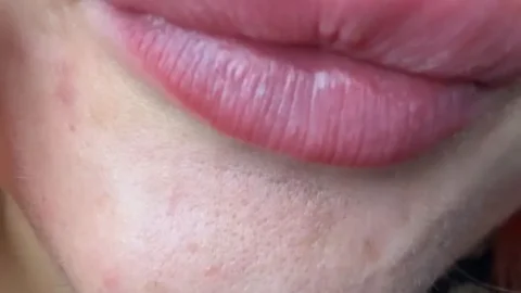 Kissing Attack